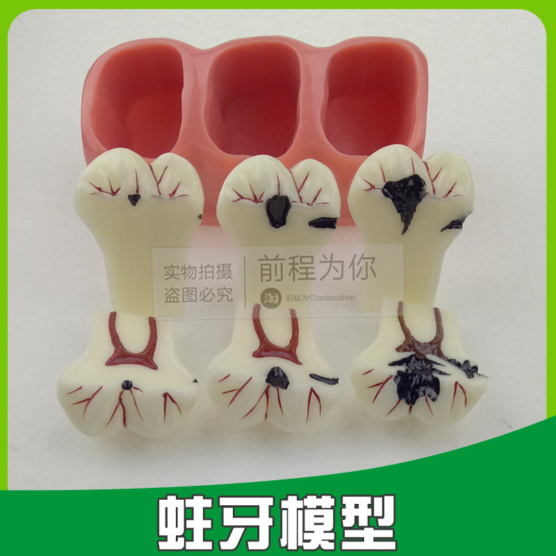 牙齿蛀牙模型龋齿演示发展模型口腔诊所医患通模型牙科教学模型