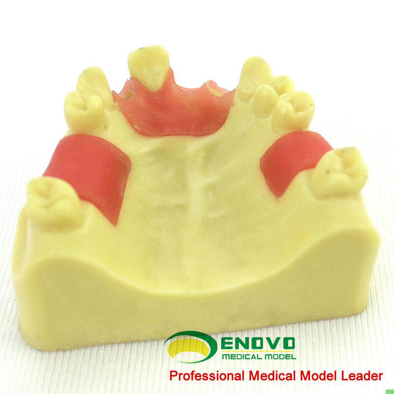 ENOVO正品牙医口腔种植培训上颌骨缺失牙齿科种植体操作练习模型