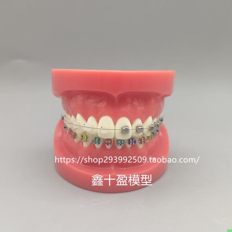 牙科正畸模型 球形金属自锁托槽正畸模型矫正练习模型医患沟通