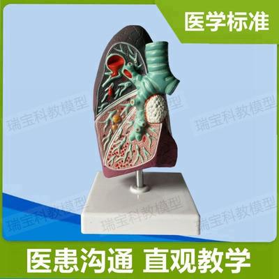 肺解剖模型e病理支气管肺泡组织呼吸道医患沟通医药礼品老年人肺