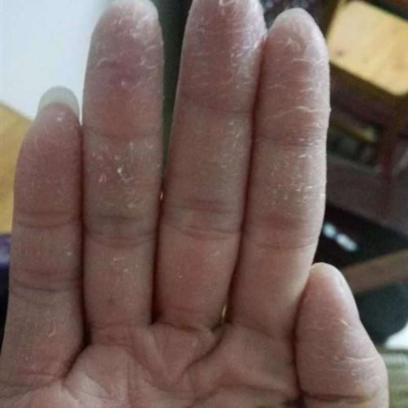 手足脱皮膏手掌上起皮干燥手脱皮儿童可用脚干裂掉皮褪皮外用软膏