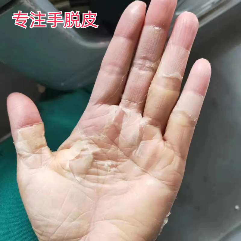 手掌手指头手脱皮膏手上起皮干燥严重蜕皮专用儿童手脚干裂褪皮掉
