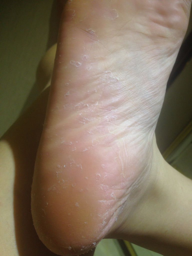 脚趾缝烂痒脱皮小水泡顽固脚痒脚臭草本萃取清洁护理止痒抑菌软膏