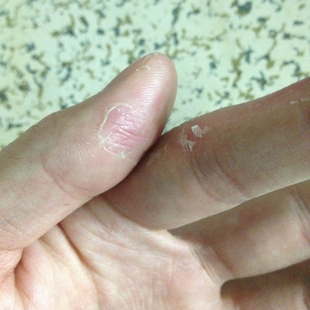 手指头裂口子干裂修复护手霜开裂脱皮裂开手足开口手脚夏季皲裂膏