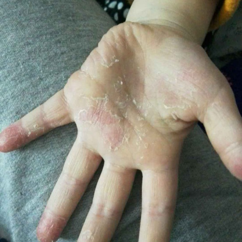 手足脱皮严重脱皮专用手指头蜕皮脚手掌干燥起皮掉皮脚底开裂乳膏