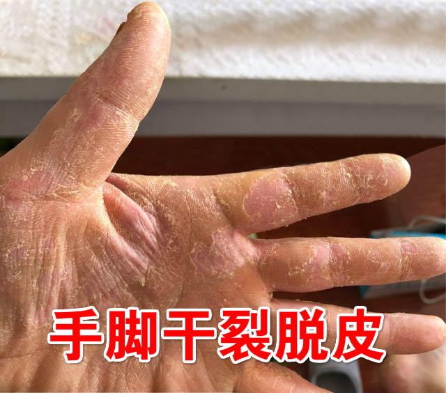 【老板娘亲测有用 一抹就不痒了】买二送一 优惠活动进行中