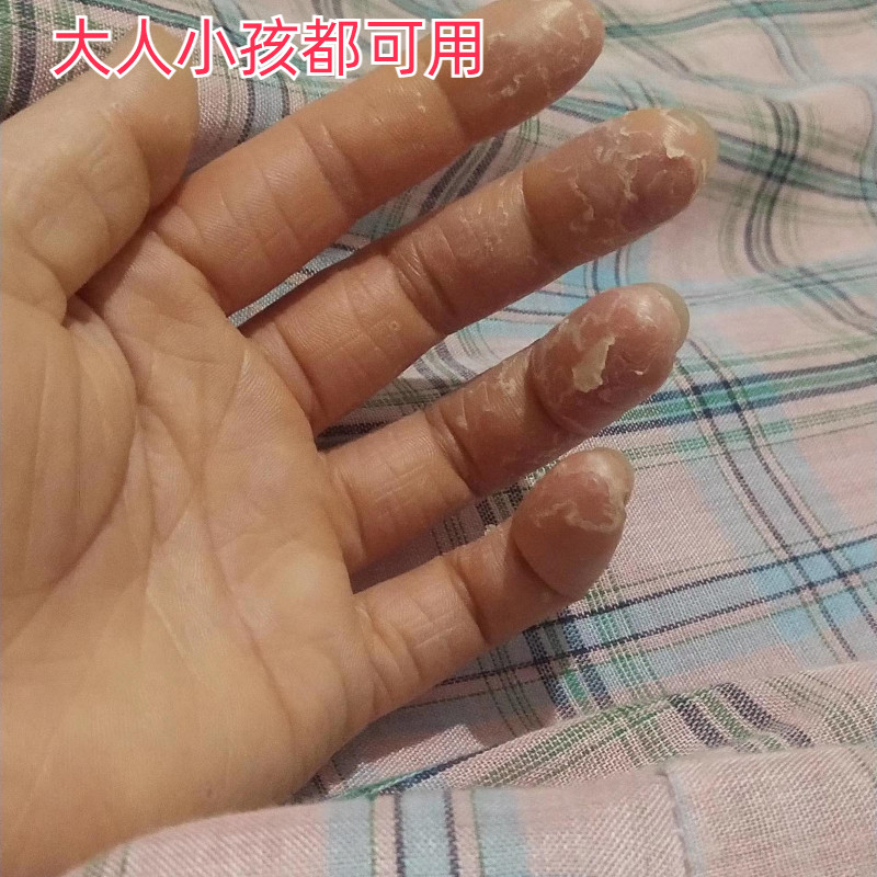 今年抖音同款手掌手指脚手掉皮脚底干燥脱皮蜕皮爆皮褪皮膏修复霜