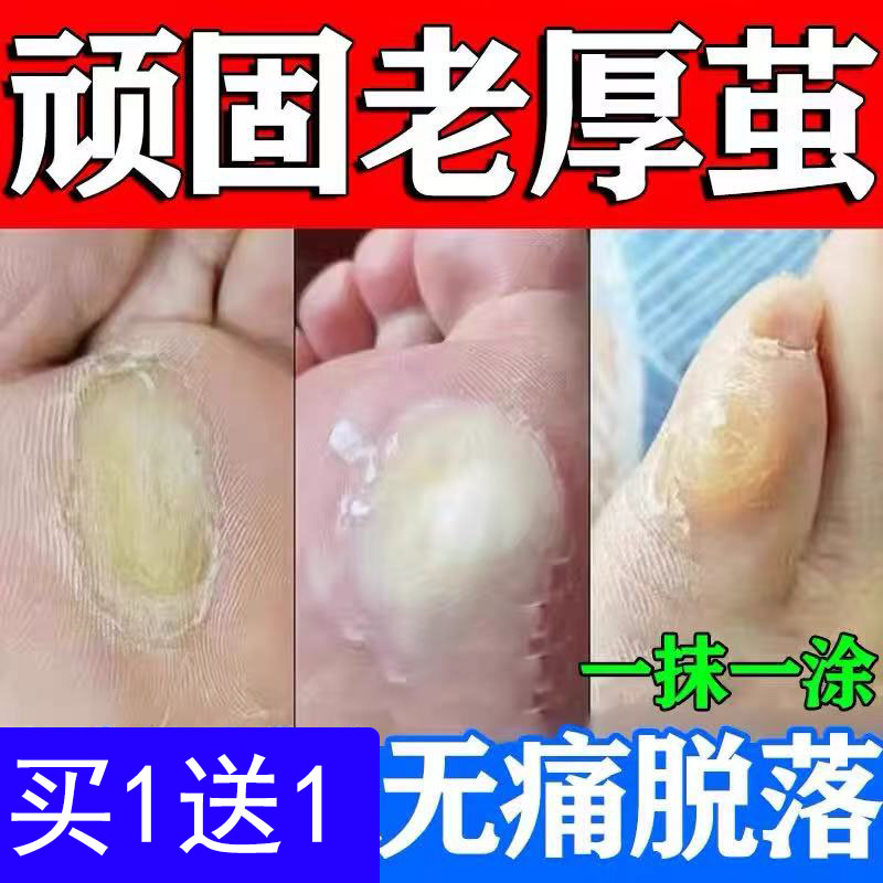 水杨酸鸡尤液正品鸡眼软化药膏跖尤老茧软化去角质老茧去脚钉除膏