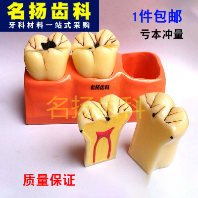 教学模型 口腔病理模型 四倍龋齿分解 牙齿模型 虫牙 根管 早教