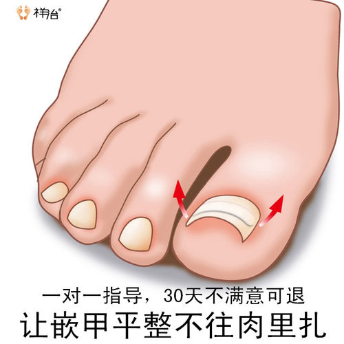 拉拉专用修脚套装正甲贴