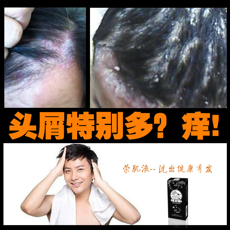荣肌液去大块头皮屑多头皮痒止痒去屑洗发水男女去屑洗发膏脂溢性