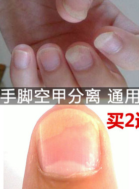 空甲修复手指分离营养不良亮脚