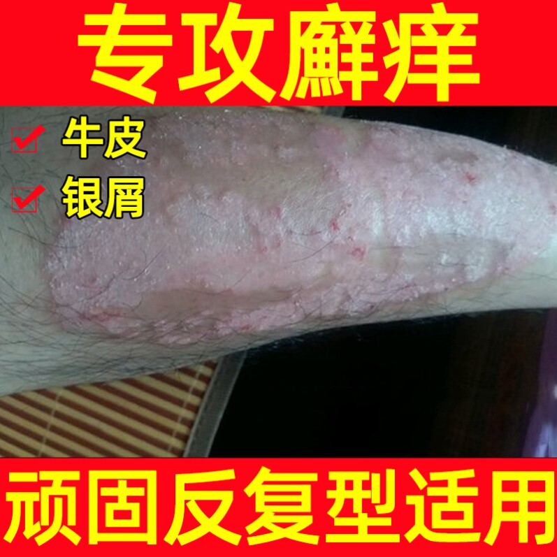 除螨药膏人用银屑癣洗发水大苗方药膏去鸡皮疙瘩药膏治疗干疮的药