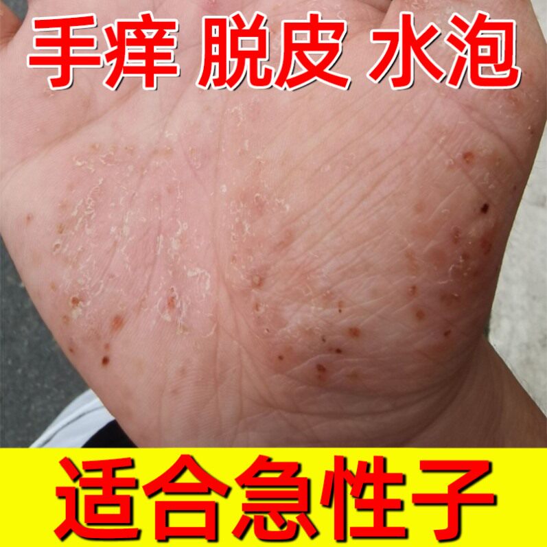 汗疱疹汗泡疱疹药膏汉状真菌感染手气膏小水泡银屑病真菌感染药膏
