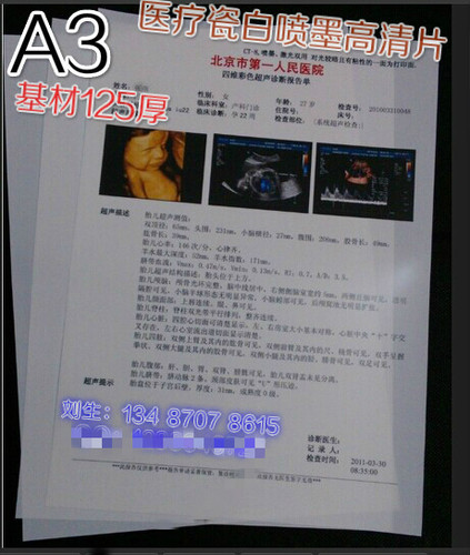 瓷白新型医用彩色喷墨防水胶片纸胃镜彩超CT片DR医疗胶片