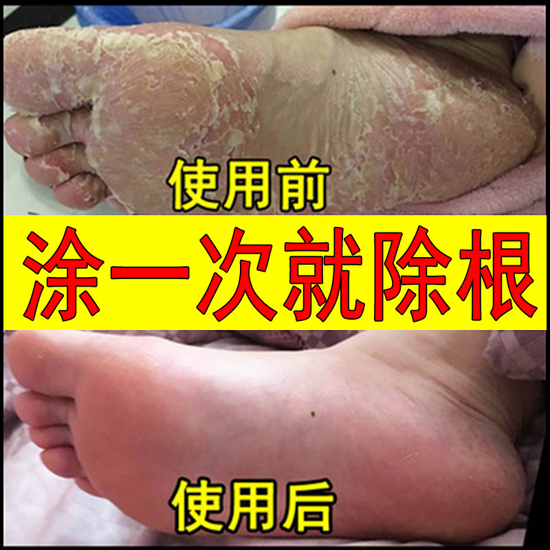 脚气止痒脱皮杀菌真菌感染