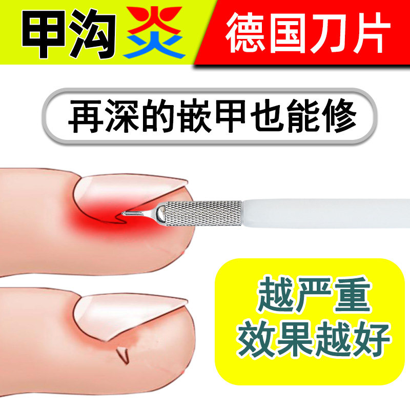 德国甲沟炎修甲刀家用工具嵌甲修脚刀指甲钳家用U型指甲扎肉修刀