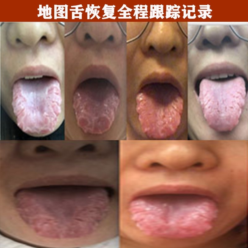 舌头裂纹地图舌调理灼口综合症裂纹舌头裂缝舌裂纹舌头地图舌口疮