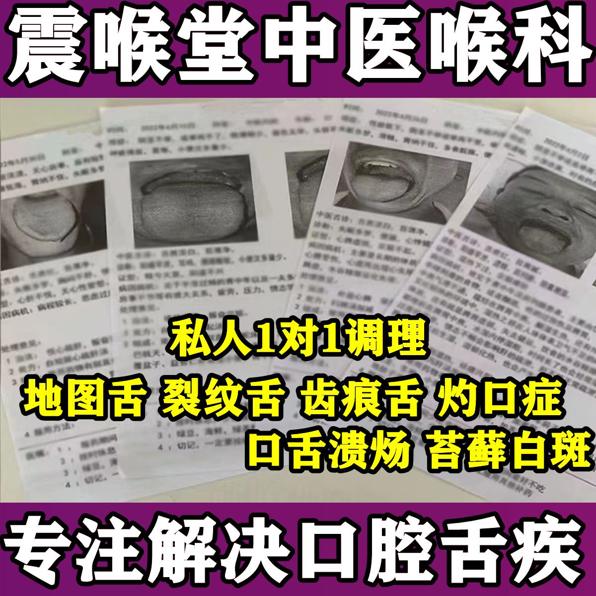 口舌白斑口舌扁平藓口腔扁平苔癣的药口癣舌藓网纹状苔藓白斑舌头