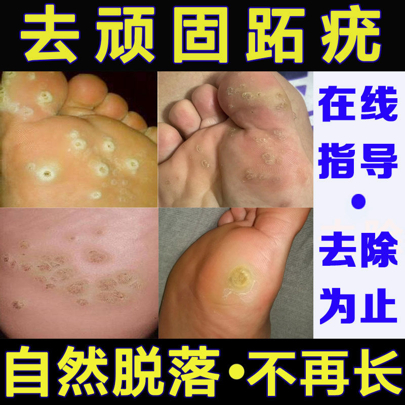 跖尤专用膏去肉刺猴根拓尤贴疣瘊净血泡刺石胞脚底趾尤神器硬疙瘩 - 实物图