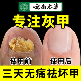 云南本草灰指甲套装 脱甲膏旗舰店修甲修脚刀冰醋酸灰甲抑菌液 正品