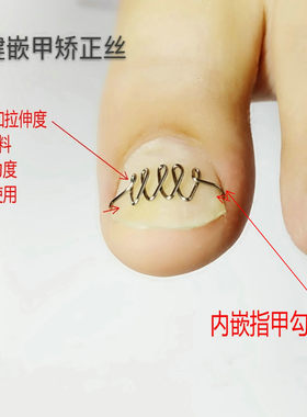 嵌甲矫正器修脚指甲趾甲不锈钢