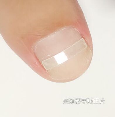包邮嵌宗健嵌矫正器贴片指甲