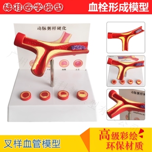 教学仿真人体病理血管堵塞动支脉粥样硬化心血管模型堵塞程度变化