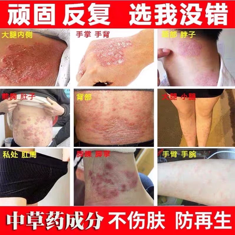 糖皮质激素软膏草本抑菌乳膏顽固瘙痒通用大腿处止痒抑菌膏外用膏