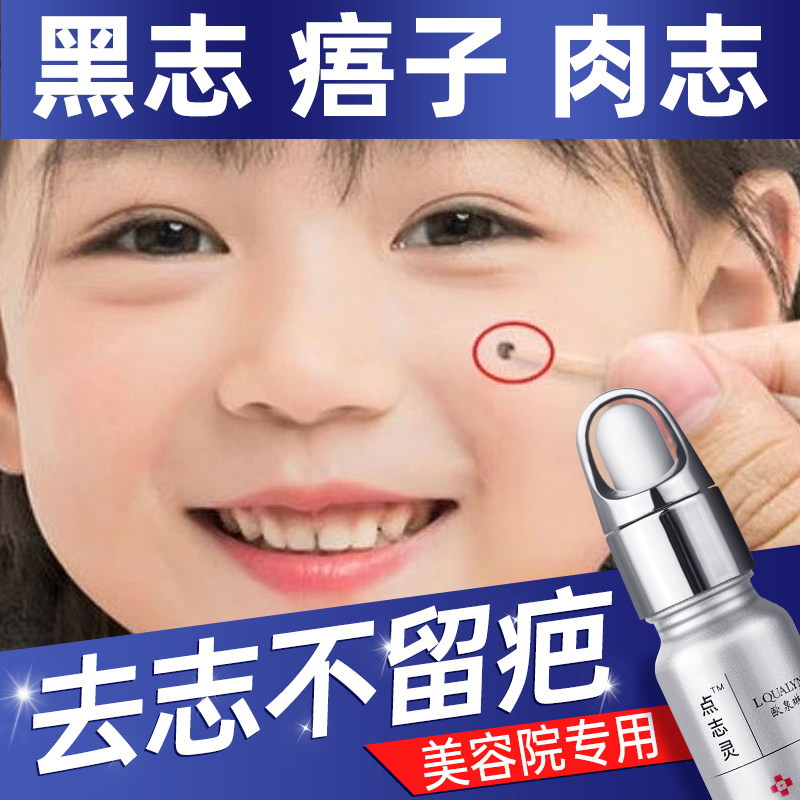 点痣膏无痕正品旗舰店脸部去痣淡斑神器非药水点斑专用液