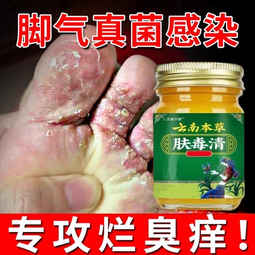 直播同款脚痒出汗烂脚丫脚气专用