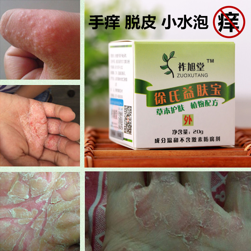 季节性手脱皮脚脱皮手痒起小水泡脚痒手干燥开裂口皲裂皮肤止痒膏