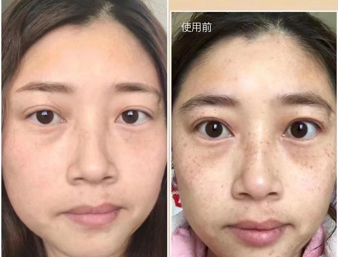 斑点  脸上斑点