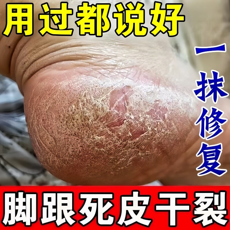 五毒脚后跟干裂修复霜手足龟裂开裂滋润治起皮去死皮润马油皱裂膏