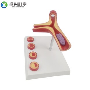 Y型动脉模型硬化带血栓模型 教学模型供应