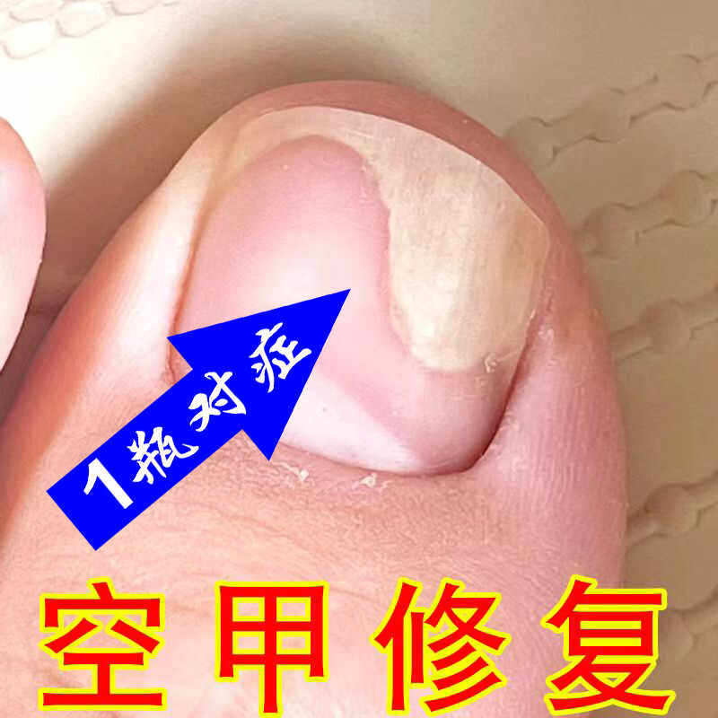 治指甲变空心甲床甲肉分离修复营养液空甲受损竖纹分层剥保养护油