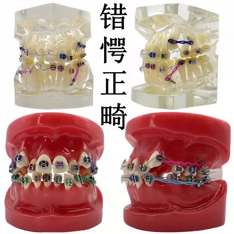 牙科正畸矫正模型金属自锁陶瓷托槽金属托槽对比模型儿童错愕正畸