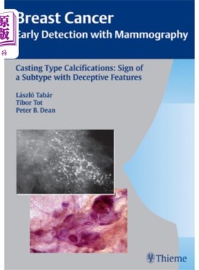 海外直订医药图书Casting-Type Calcifications: Sign of a Subtype w... 铸造型钙化:具有欺骗性特征的一种亚型的迹象