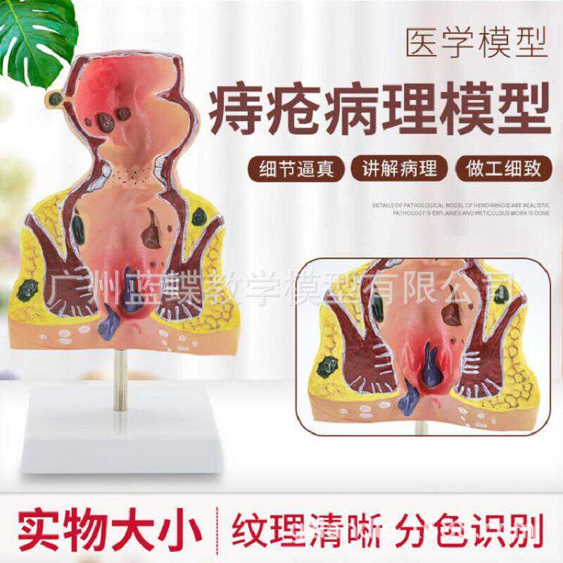 专业人体痔疮疾病模型直肠痔疮病理模型肛楼探针肛管模型肛门