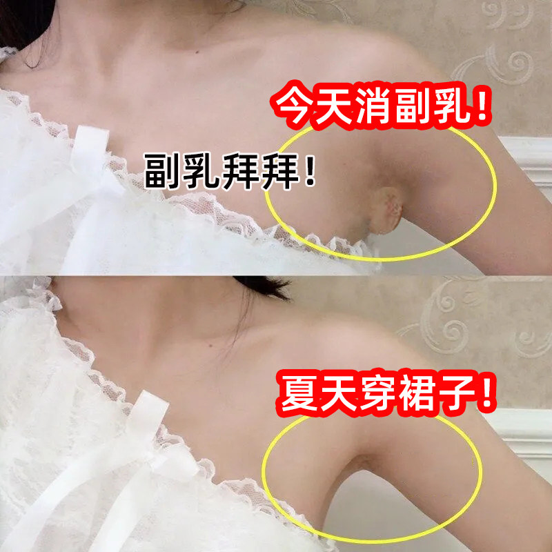 去副乳神器消除贴膏腋下淋巴结耳后颈脖子肿大硬块没了疏通散结节