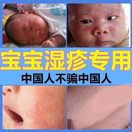 湿疹婴儿专用口水疹膏热疹宝宝奶藓膏去痤疮儿童特应性皮炎止痒根