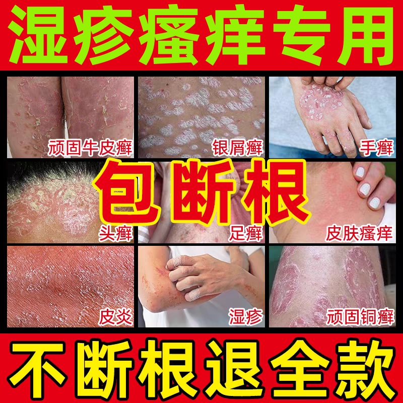 治疗银屑病牛皮藓专用药膏