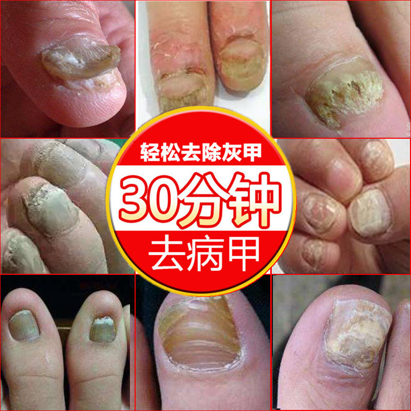专用精油后期甲清增厚抑菌液