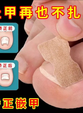 正甲贴甲沟垫片嵌甲专用指甲矫正