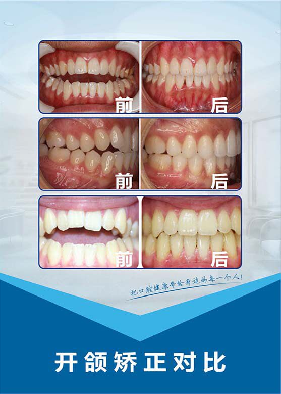 770牙科口腔门诊开颌矫正对比图贴挂画喷绘素材展板海报印制1340