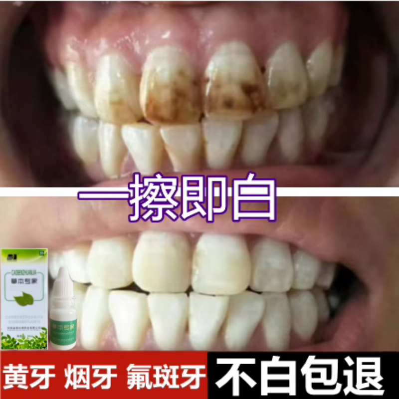 牙齿美白速效去除黄牙烟渍氟斑牙洗牙液去黄污垢变白药水专用神器