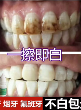 【牙科推荐】去除黄牙烟渍氟斑牙