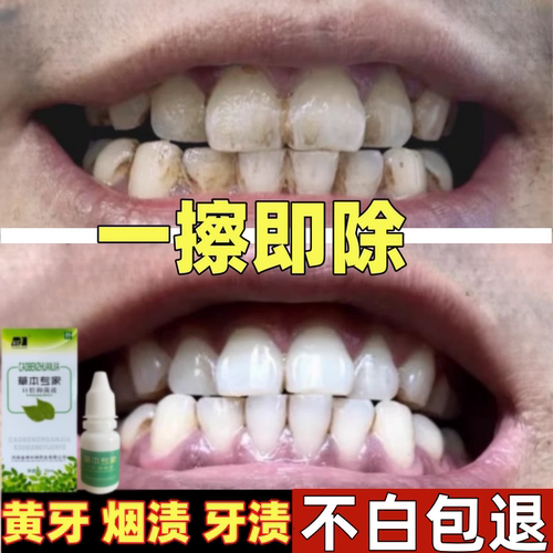 【一擦即除】黄牙烟渍茶渍牙垢