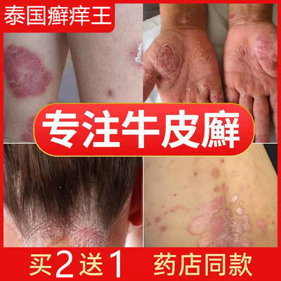 股癣大腿内侧囊瘙痒湿疹肛门屁股阴私处藓癬真菌感染男女专用