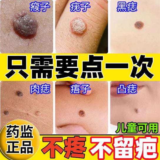点痣膏无痕正品旗舰店祛痣药水不留疤点痣点斑去痦子专用修护液pk